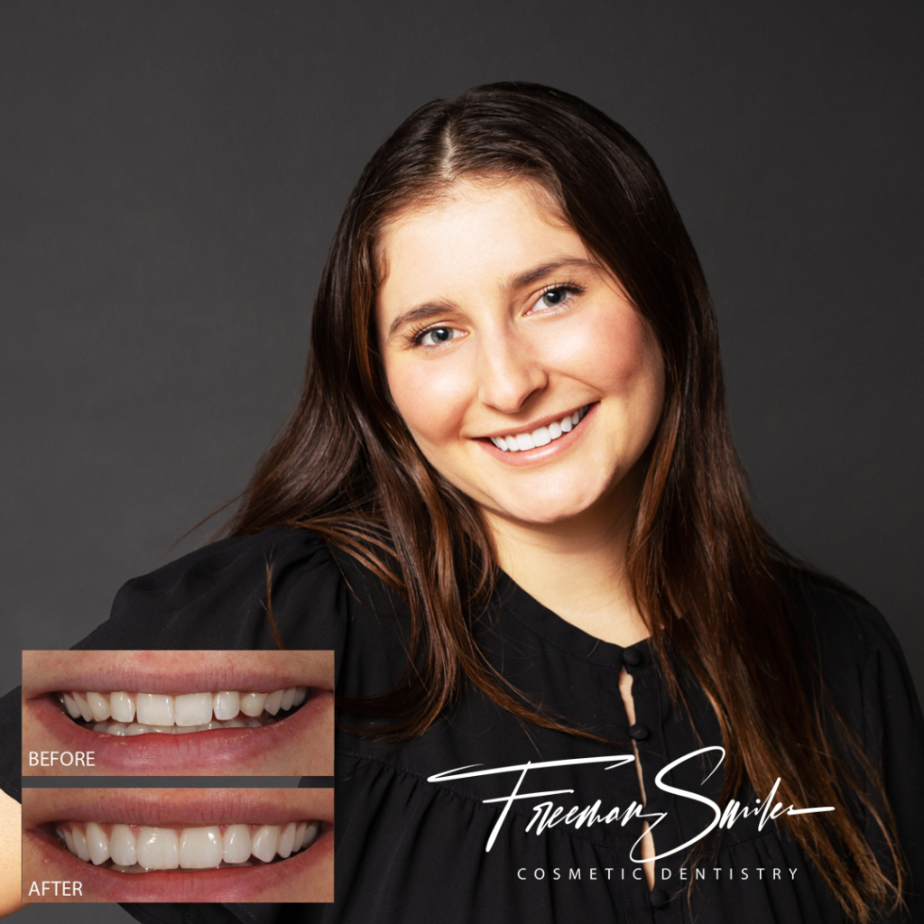 Porcelain Veneers Freeman Smiles Cosmetic Dentistry Bend Oregon