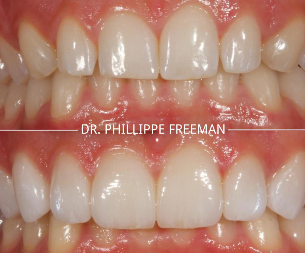 Porcelain Veneers Freeman Smiles Cosmetic Dentistry Bend Oregon