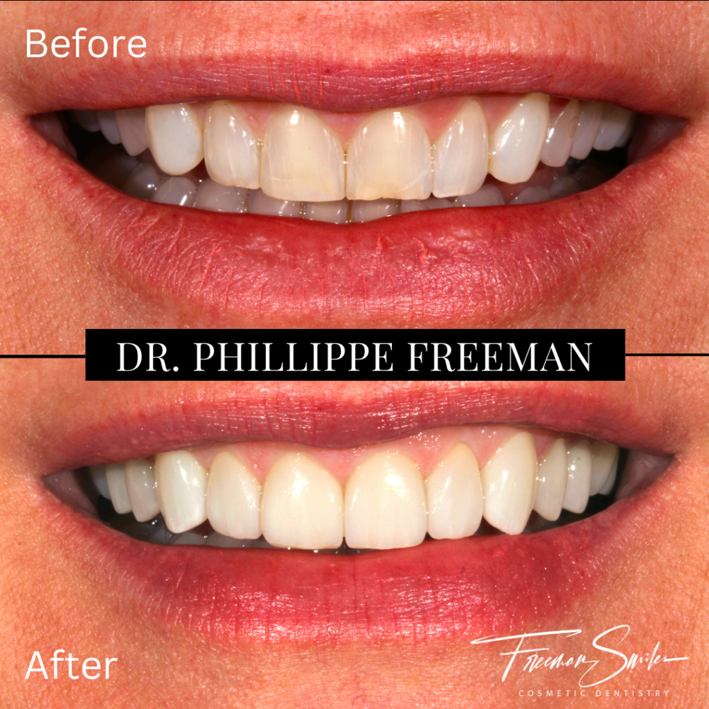 Prepless Veneers Freeman Smiles Cosmetic Dentistry Bend Oregon