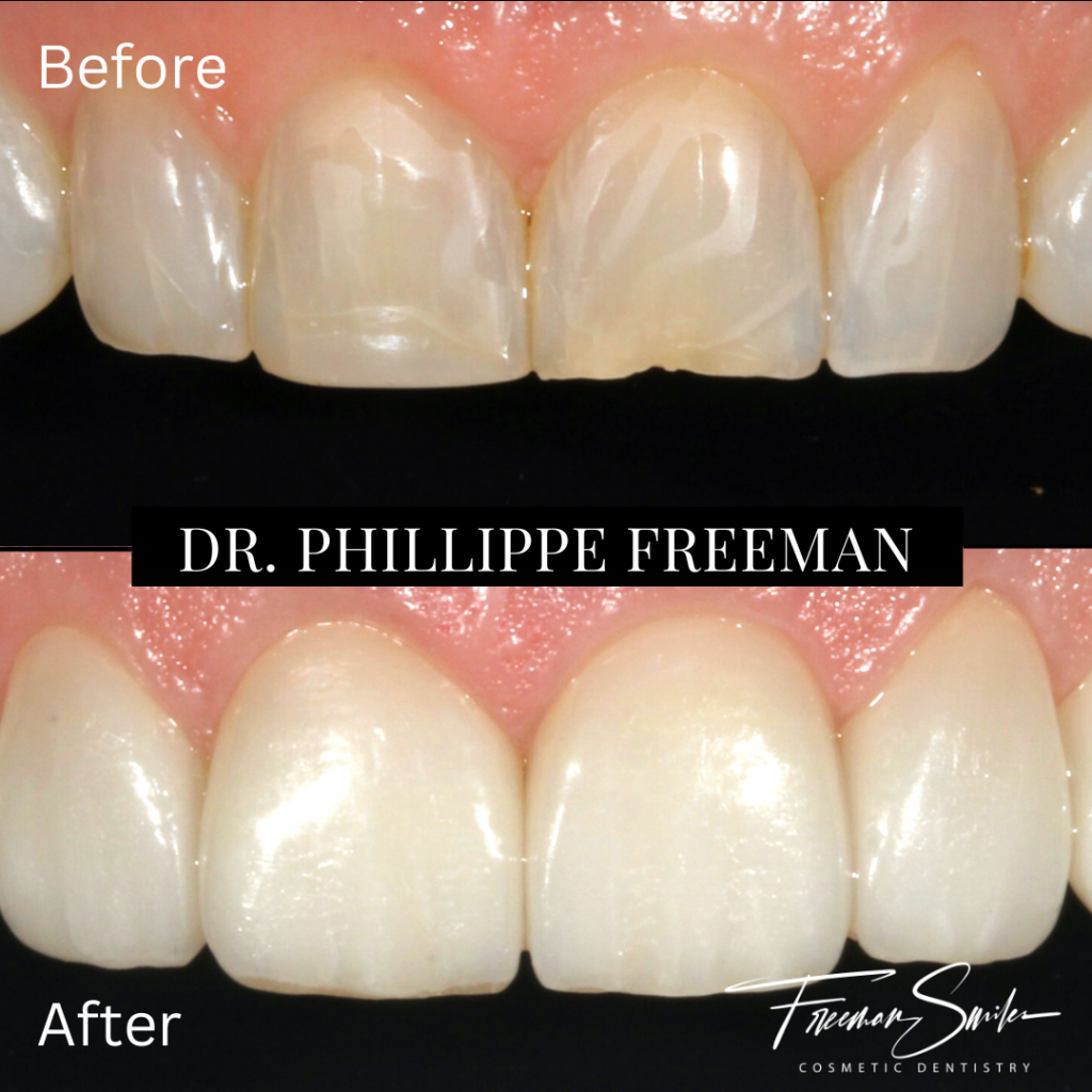 Prepless Veneers Freeman Smiles Cosmetic Dentistry Bend Oregon